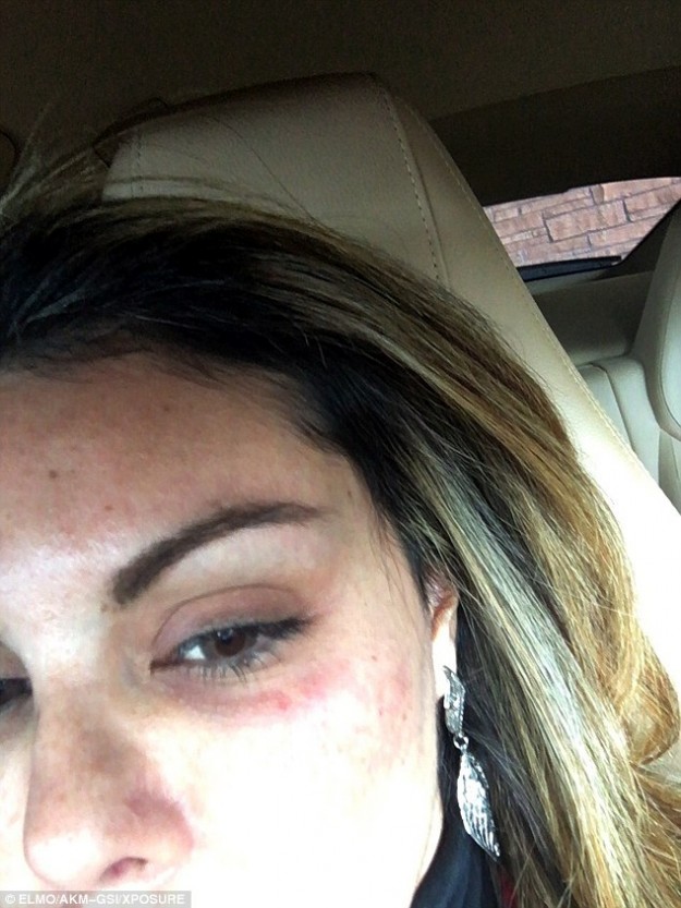 The alleged victim with bruising around her eye. 
